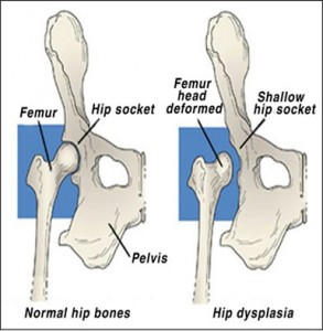 Hip socket depth - Brisbane Back Pain Program | McGill Certified Practitioner | Online Coaching Hip socket depth
