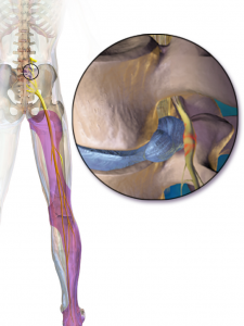 Sciatica-large - Brisbane Back Pain Program | McGill Certified Practitioner | Online Coaching