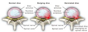 bulging-herniated-disc - Brisbane Back Pain Program | McGill Certified Practitioner | Online Coaching