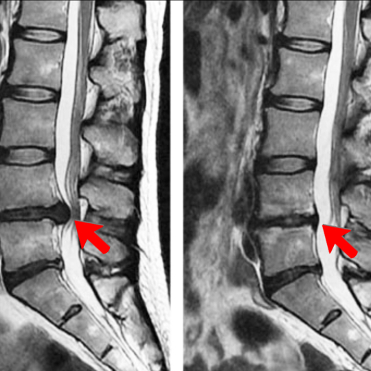 DiscBulgeHeal540 - Brisbane Back Pain Program | McGill Certified Practitioner | Online Coaching MRI image showing a comparison of an active disc bulge vs the bulge having healed.