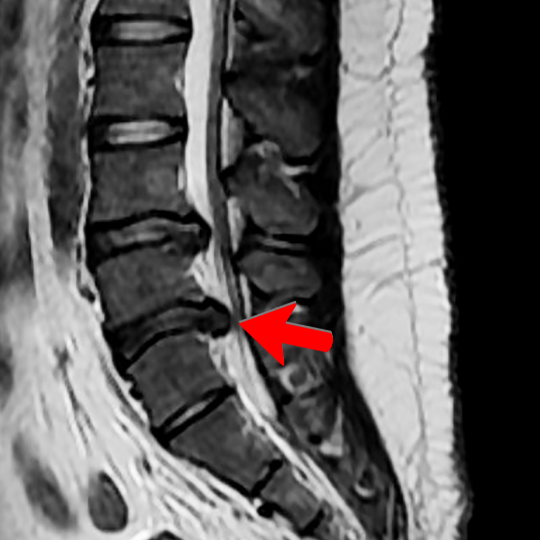 DiscHerniationWithArrow540 - Brisbane Back Pain Program | McGill Certified Practitioner | Online Coaching MRI image of a disc herniation at L4-L5