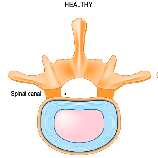 HealthyForamen540 - Brisbane Back Pain Program | McGill Certified Practitioner | Online Coaching Simplified medical diagram of a healthy vertebra with a healthy spinal canal.