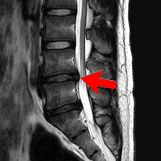 L4-L5Bulges - Brisbane Back Pain Program | McGill Certified Practitioner | Online Coaching MRI image of the lumbar spine, showing disc bulges at L4-L5 and L5-S1.
