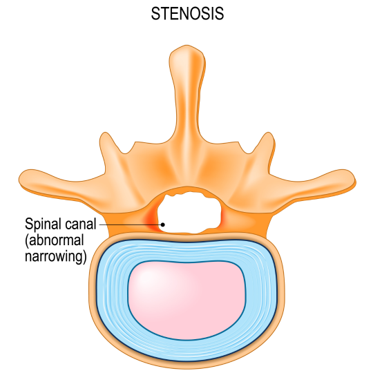 StenoticForamen540 - Brisbane Back Pain Program | McGill Certified Practitioner | Online Coaching Diagram of a vertebra with a stenotic spinal canal.