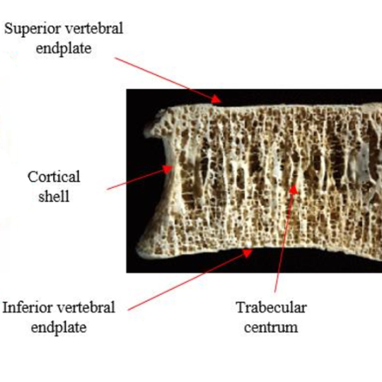TrabecularBone - Brisbane Back Pain Program | McGill Certified Practitioner | Online Coaching Photo of a lumbar vertebra cut vertically to expose the inner structure.