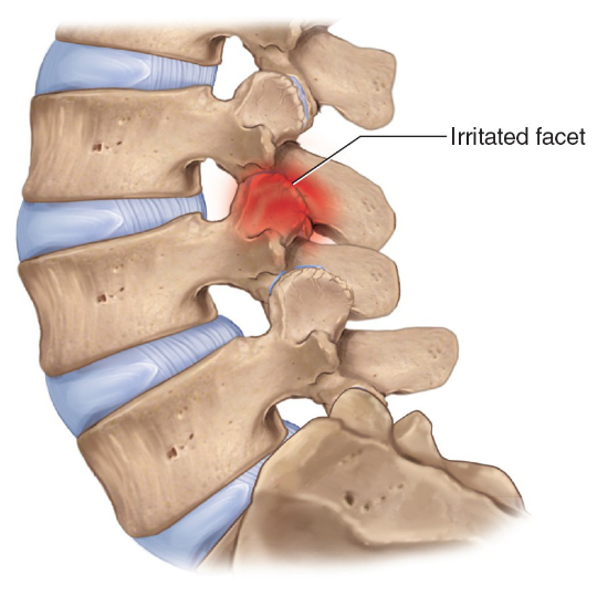 irritatedFacectJoint - Brisbane Back Pain Program | McGill Certified Practitioner | Online Coaching