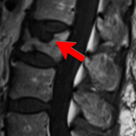 EndPlateFractureMRI540 - Brisbane Back Pain Program | McGill Certified Practitioner | Online Coaching