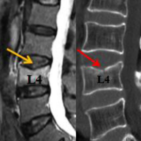 EndPlateFractureMRIandCT540 - Brisbane Back Pain Program | McGill Certified Practitioner | Online Coaching