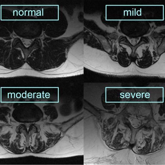MultifidusAtrophy540 - Brisbane Back Pain Program | McGill Certified Practitioner | Online Coaching MRI images showing different stages of fatty infiltration of the lumber multifidus.
Shows a progression through 4 stages from normal, mild, moderate to severe.