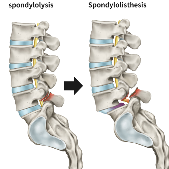 Spondylolisthesis540 - Brisbane Back Pain Program | McGill Certified Practitioner | Online Coaching Diagram showing a progression from spondylolysis to spondylolisthesis.