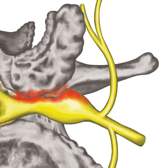 StenosisForamenCrop540 - Brisbane Back Pain Program | McGill Certified Practitioner | Online Coaching diagram of foraminal stenosis, showing impingement upon the sciatic nerve root.