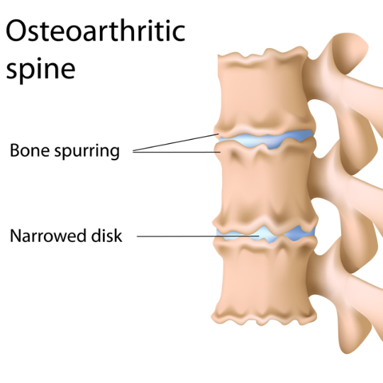 spondylosis-540 - Brisbane Back Pain Program | McGill Certified Practitioner | Online Coaching Diagram of an osteoarthritic spine showing signs of spondylosis.